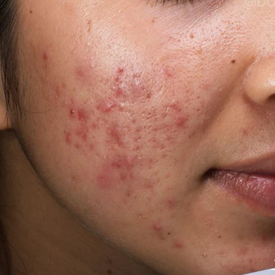 Acne